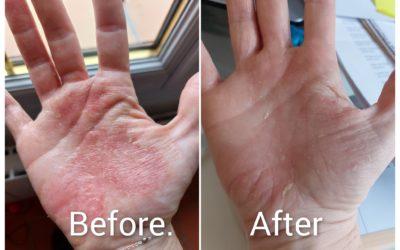 d’eczéma sur les mains