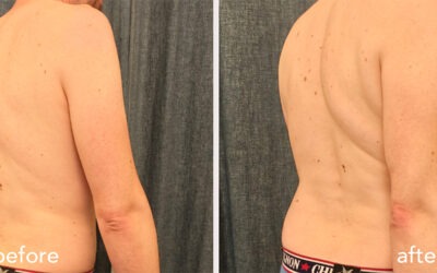 Sciatique chronique et lombalgie : amélioration du mouvement après une séance d’acupuncture globale