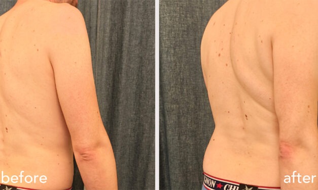 Sciatique chronique et lombalgie : amélioration du mouvement après une séance d’acupuncture globale