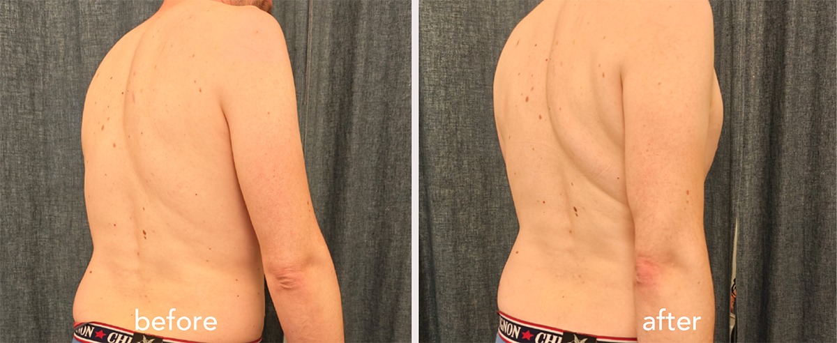 Sciatique chronique et lombalgie : amélioration du mouvement après une séance d’acupuncture globale