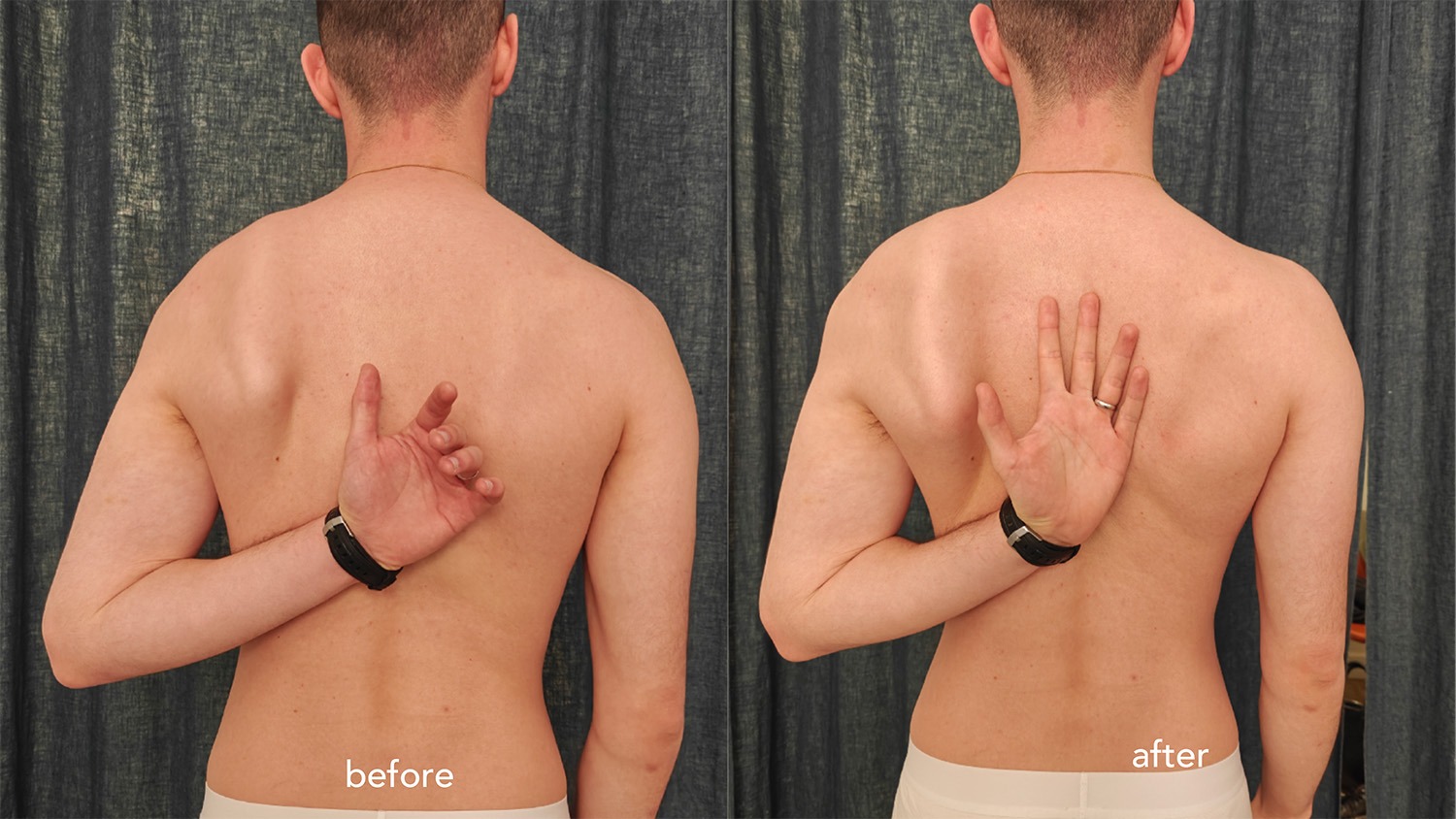 Quand traiter l’épaule ne suffit plus