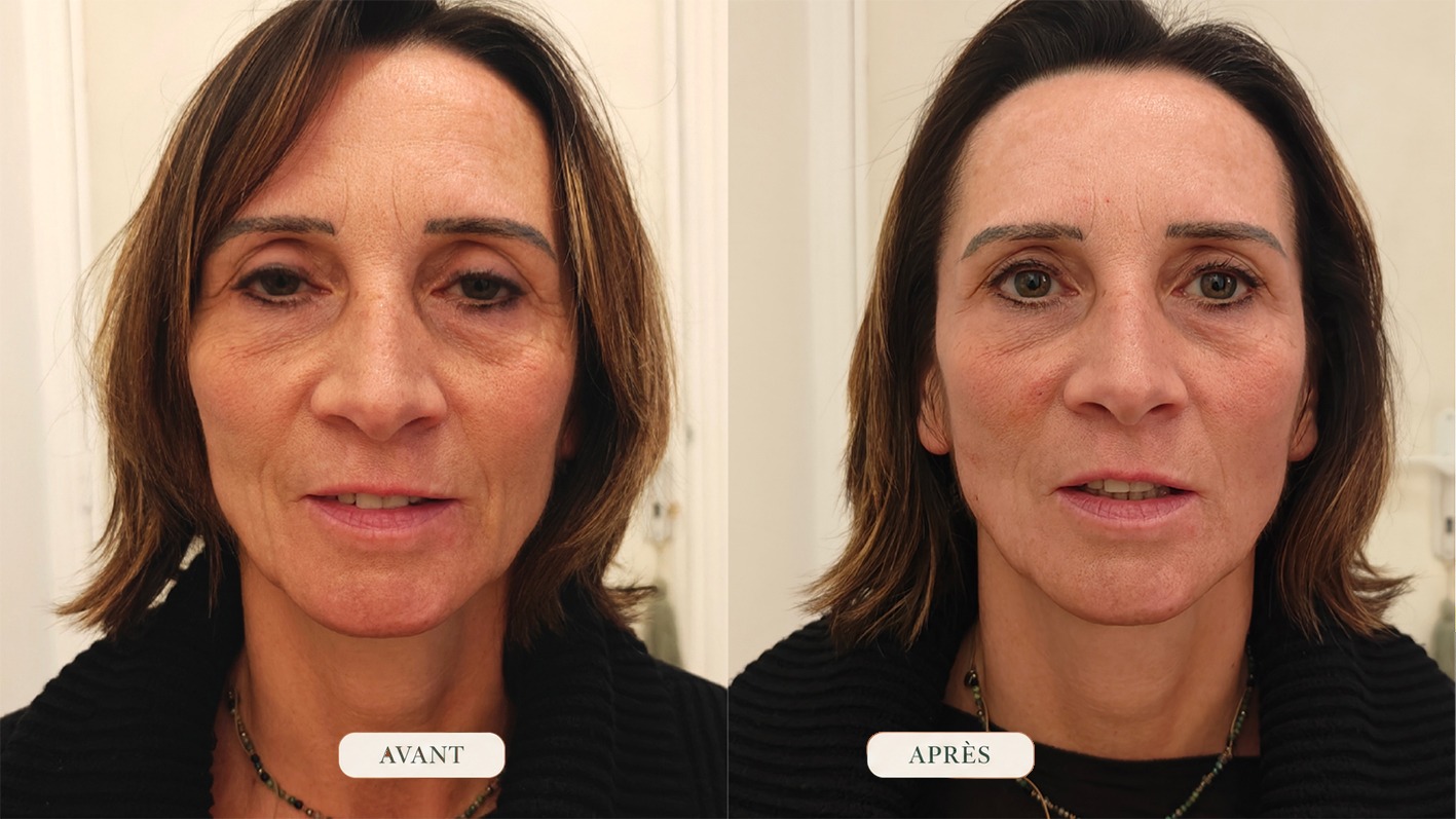 Comparaison avant et après une séance de Facial Fascial Lifting