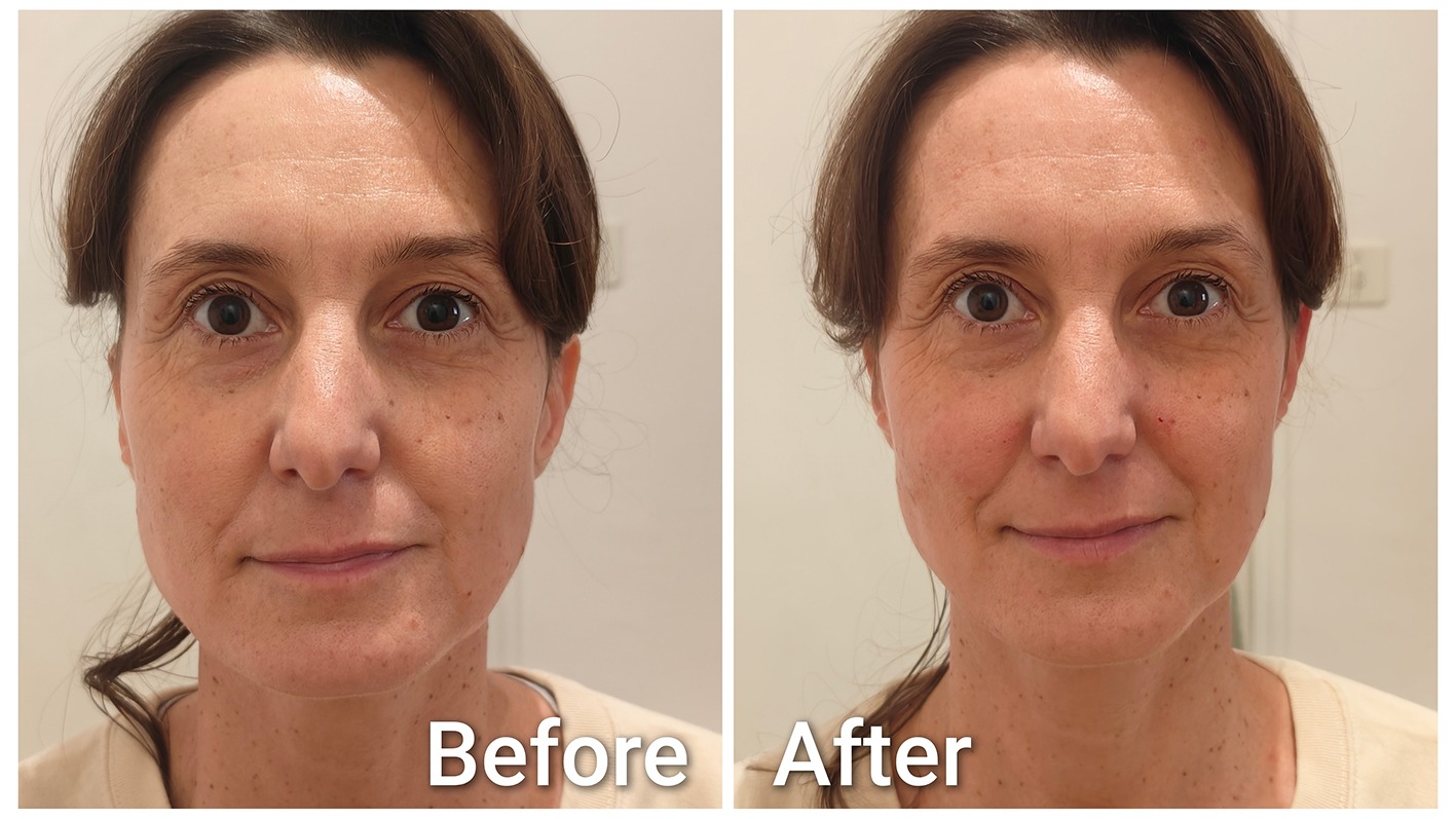 Comparaison avant et après une séance de Facial Fascial Lifting