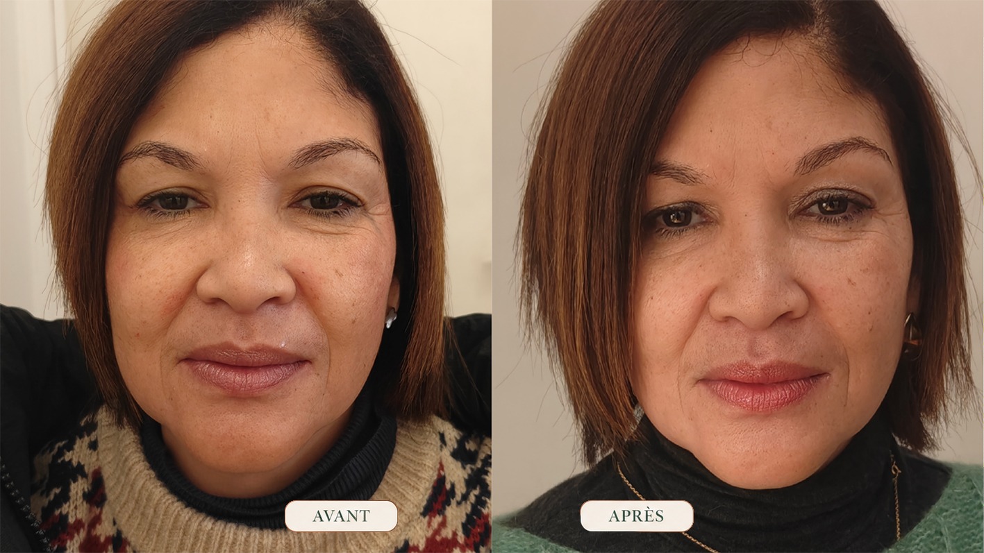 Observation clinique avant et après une séance de Facial Fascial Lifting